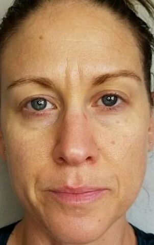 A la edad de 40 años, aparecieron arrugas profundas y puntos de edad