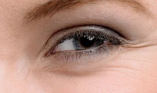 Arrugas en las esquinas de los ojos